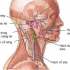 Viêm tấy mủ hạch cổ bên